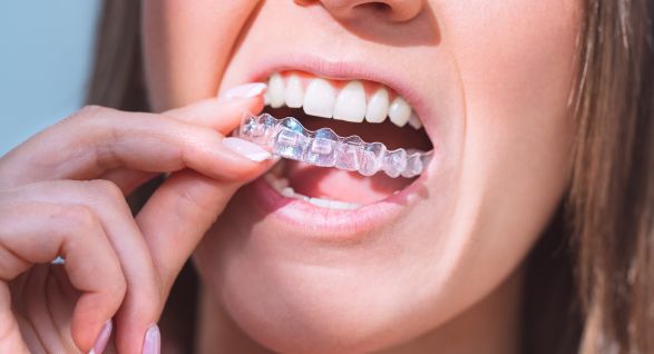 Invisalign