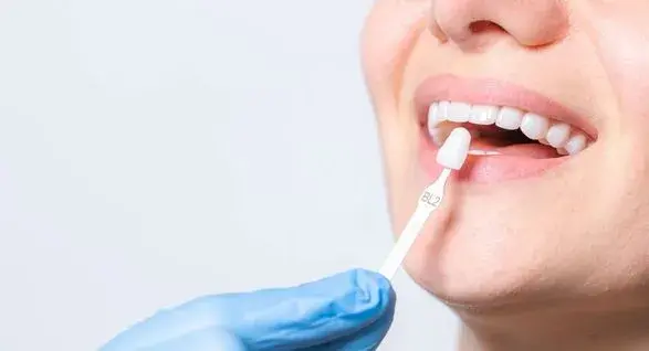Veneers