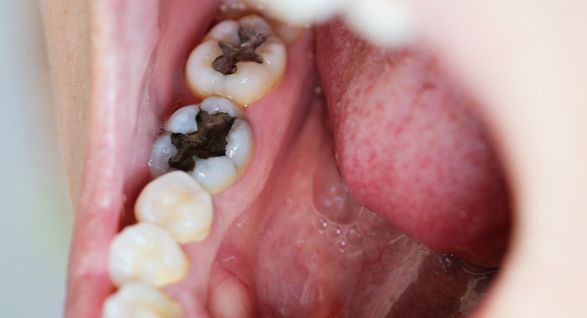 Featured image for “Tooth Pain Signs That May Need root canal Oakville Evaluation”